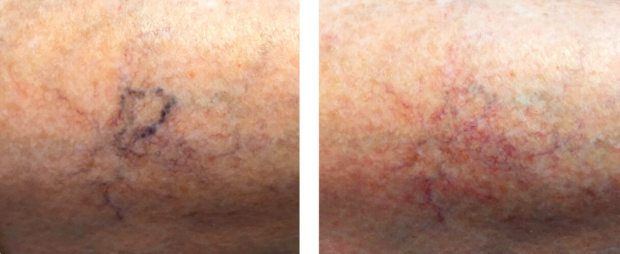 Vor und nach einer Besenreiser-Behandlung mit dem lina-60i810-Diodenlaser der intros Medical Laser GmbH