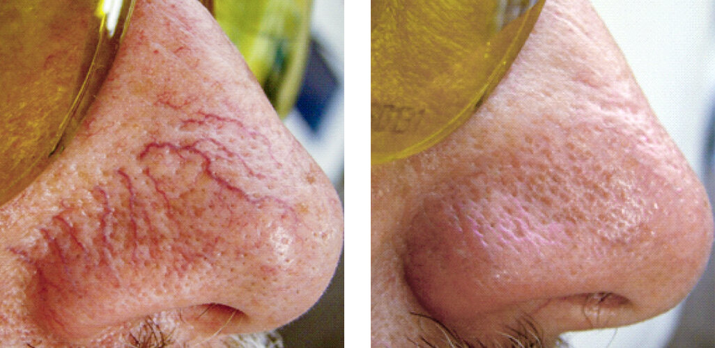 Teleangiektasien-Behandlung mit Diodenlaser der intros Medical Laser GmbH