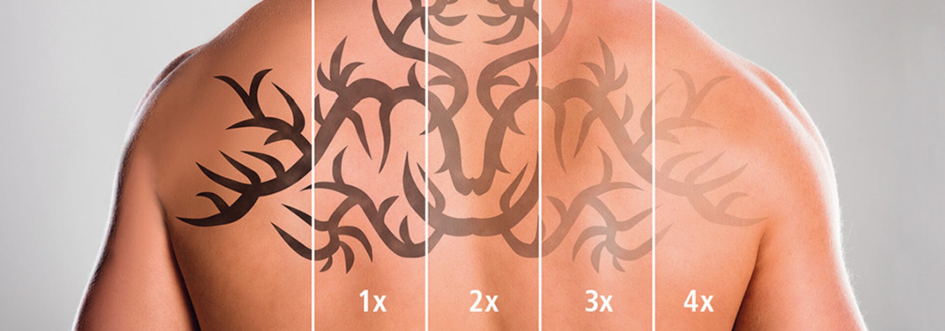 Stufen der Tattoo-Entfernung mit dem Q10 Nd:YAG-Laser der intros Medical Laser GmbH