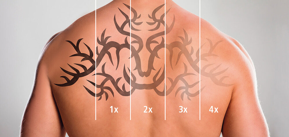 Stufen der Tattoo-Entfernung mit dem Q10 Nd:YAG-Laser der intros Medical Laser GmbH