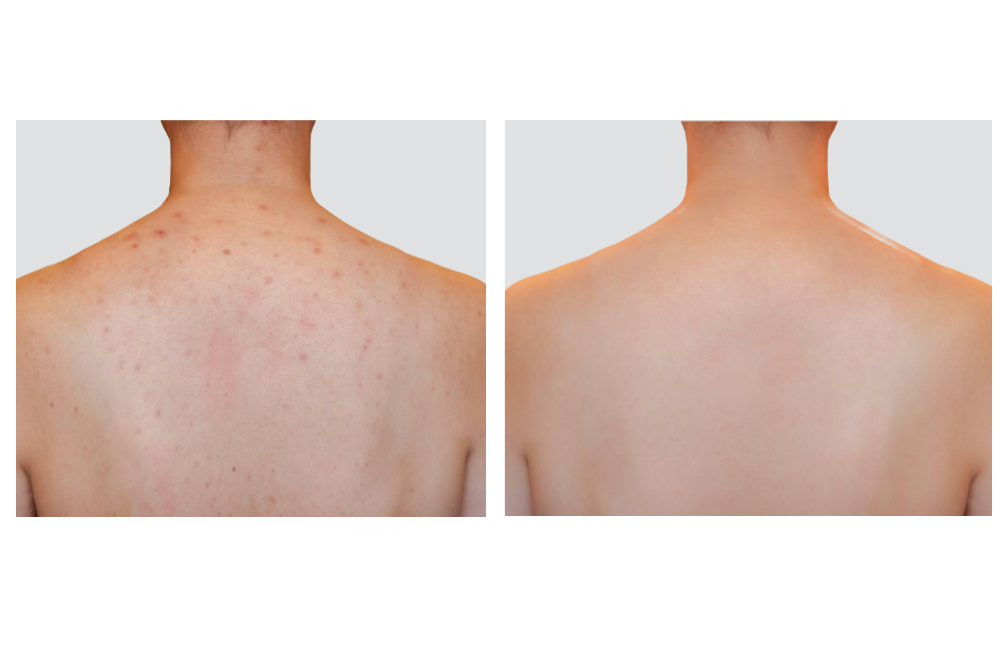Ergebnis einer Akne-Behandlung mit Lasergeräten der intros Medical Laser GmbH