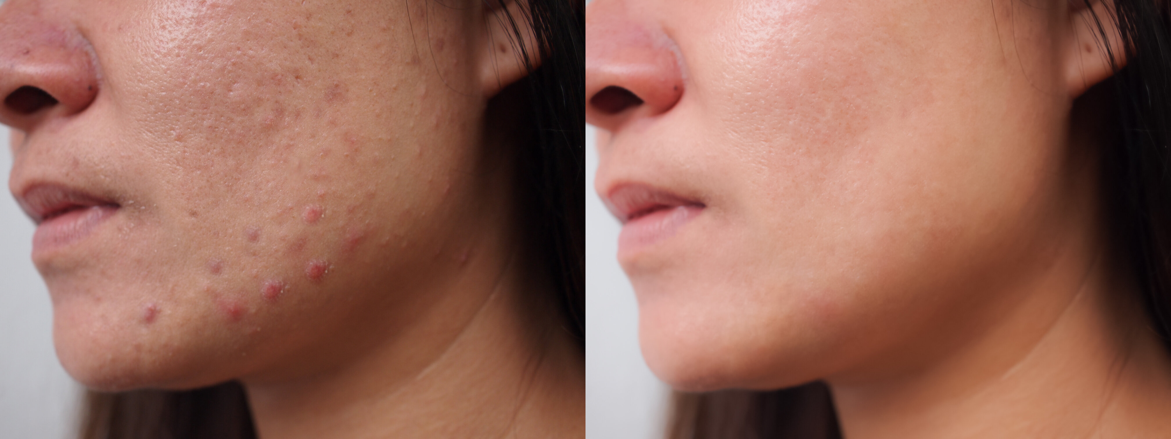 Ergebnis einer Akne-Behandlung mit Lasergeräten der intros Medical Laser GmbH
