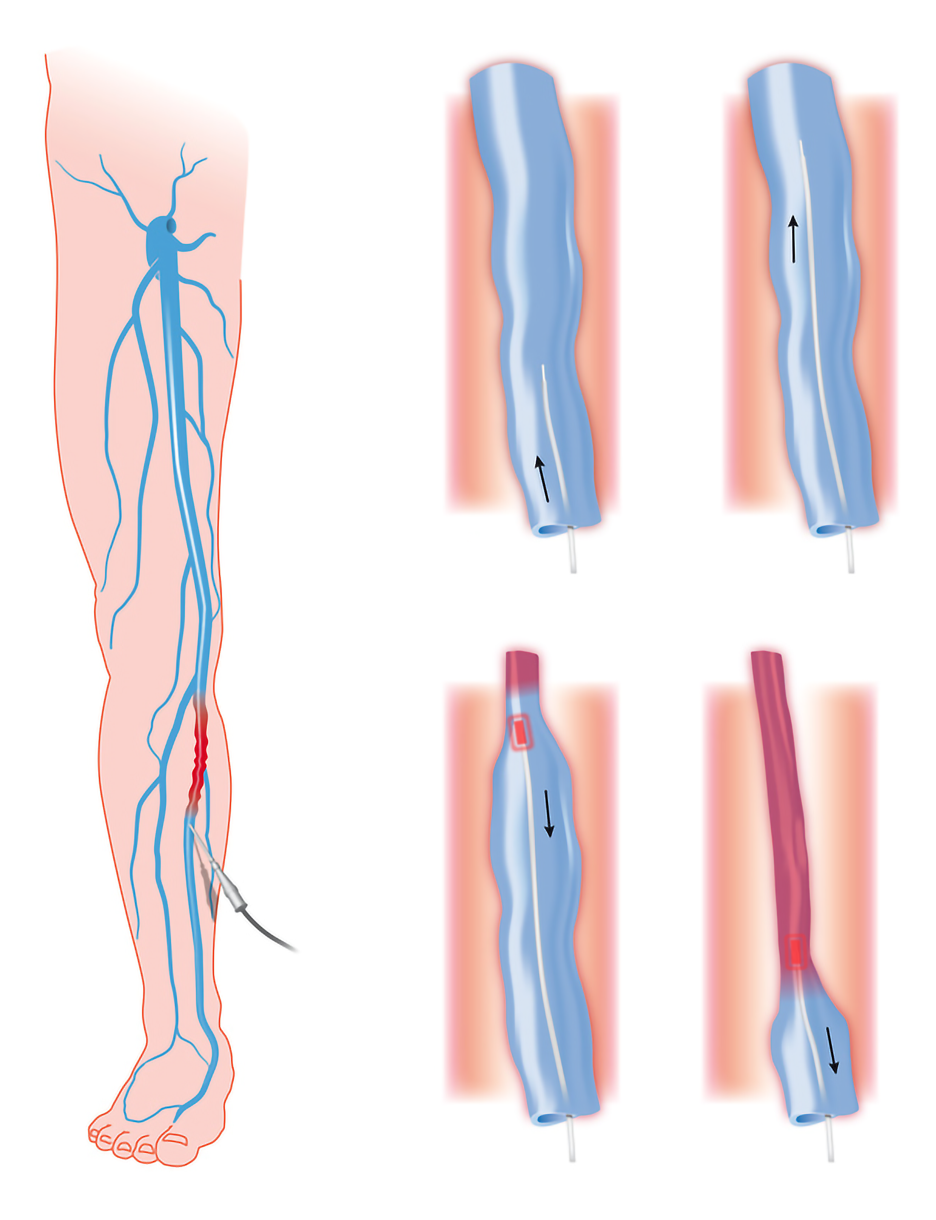 Grafik Beine Venen, so funktioniert die endovenöse Lasertherapie