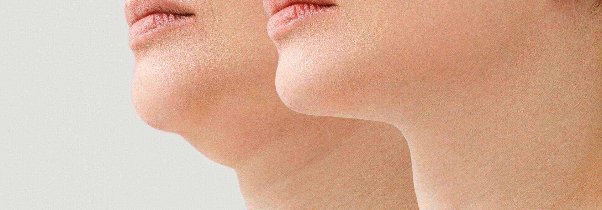 Nahaufnahme Gesicht einer Frau vor und nach der Reduktion des Doppelkinns