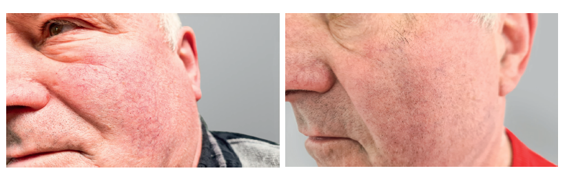 Gesicht eines Mannes vor uns nach einer Couperosebehandlung mit Laser