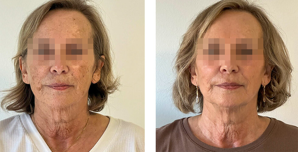 CO2-Laserbehandlung Gesicht vorher nachher mit intros Laser
