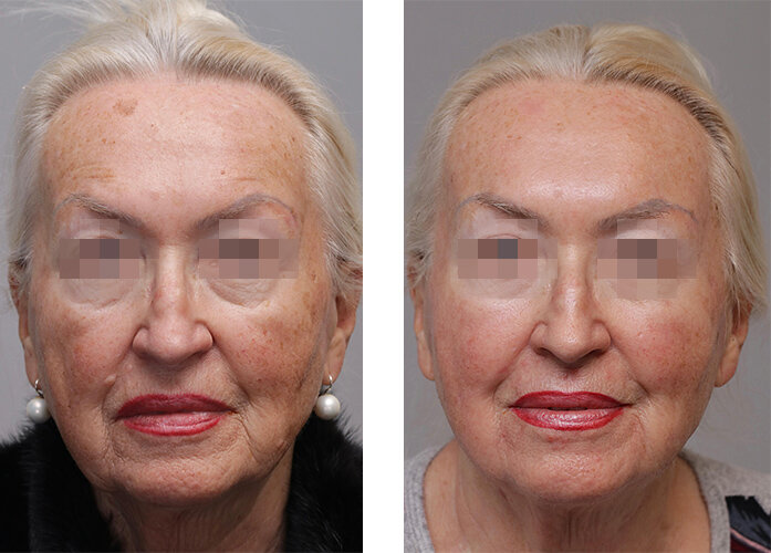Gesicht Frau vor und nach der Hautverjüngung mit RF-Needling und CO2-Laser von intros