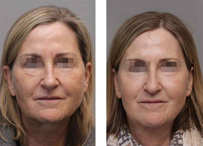 Gesicht Frau vor und nach der Hautverjüngung mit RF-Needling und CO2-Laser von intros
