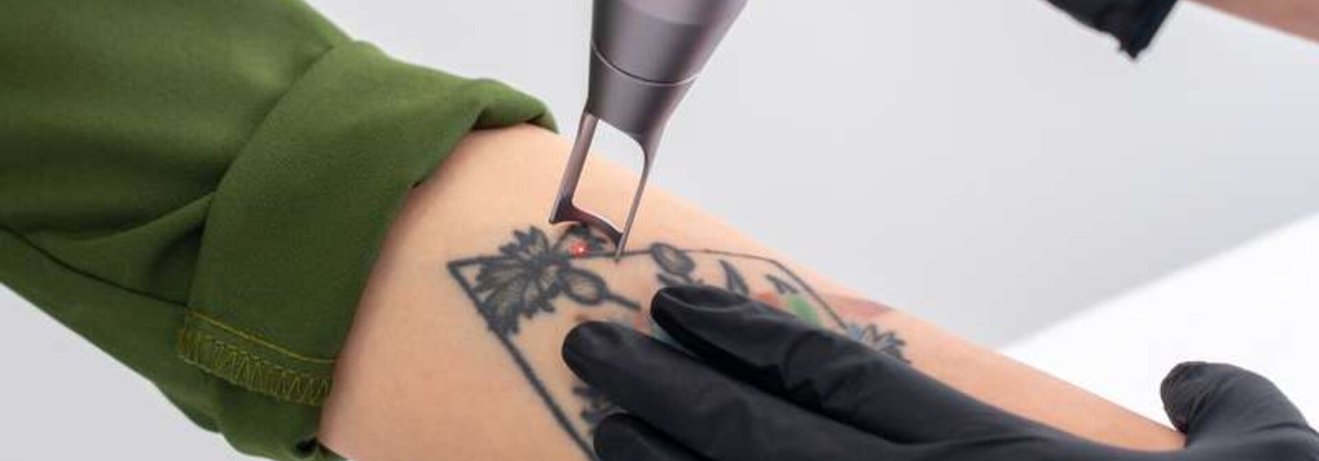 Laser entfernt Tattoo am Unterarm einer Frau