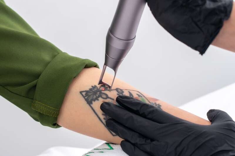 Laser entfernt Tattoo am Unterarm einer Frau
