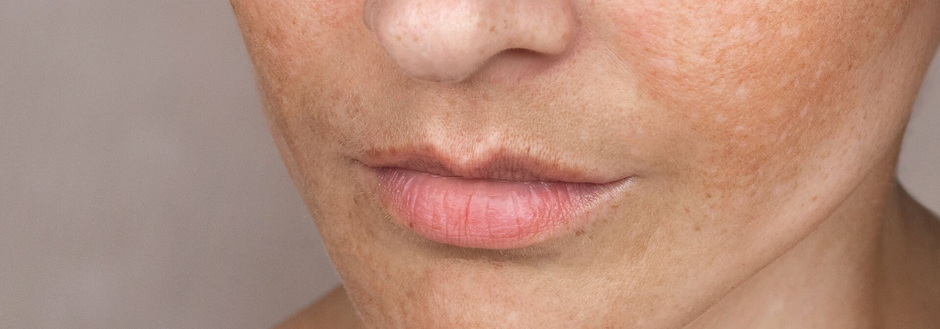 Gesicht einer jungen Frau mit Pigmentflecken und Sommersprossen