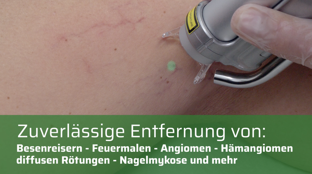 Live-Video Gefäßbehandlung mit Laser: Der Smartrion von intros