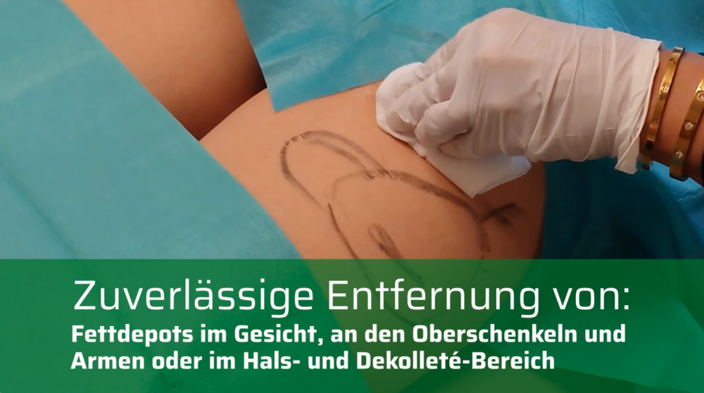 Livevideo Laserlipolyse mit intros Diodenlasern